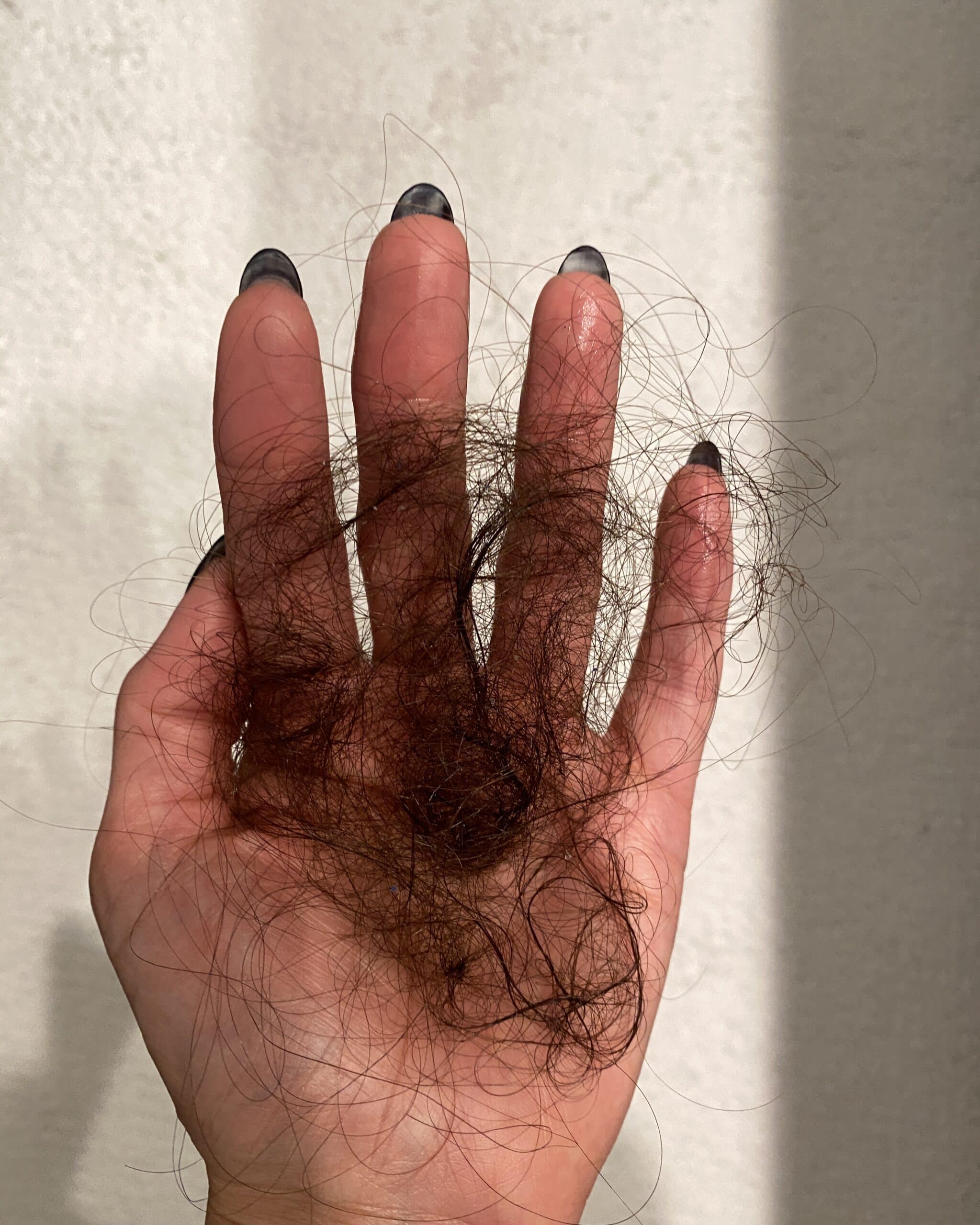 HAIR LOSS DURING A RECENT HASHIMOTO'S FLAREUP 